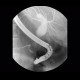 Dilatation of biliary duct, sclerosis of papilla: RF - Fluoroscopy